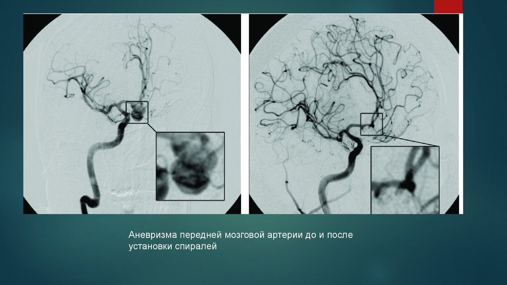 Селективная церебральная ангиография. Кт ангиография аневризма головного мозга. Селективная ангиография сосудов головного мозга. Ангиография артерий и вен головного мозга.