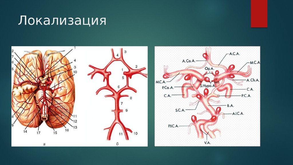 Презентация аневризмы сосудов головного мозга