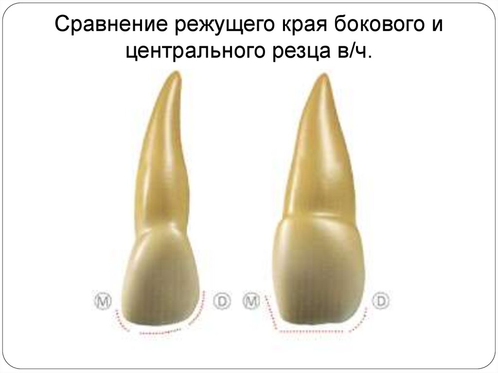 Режущий край. Центральный резец режущий край. Режущий край центральных резцов. Режущий край латерального резца. Треугольная форма центрального резца.