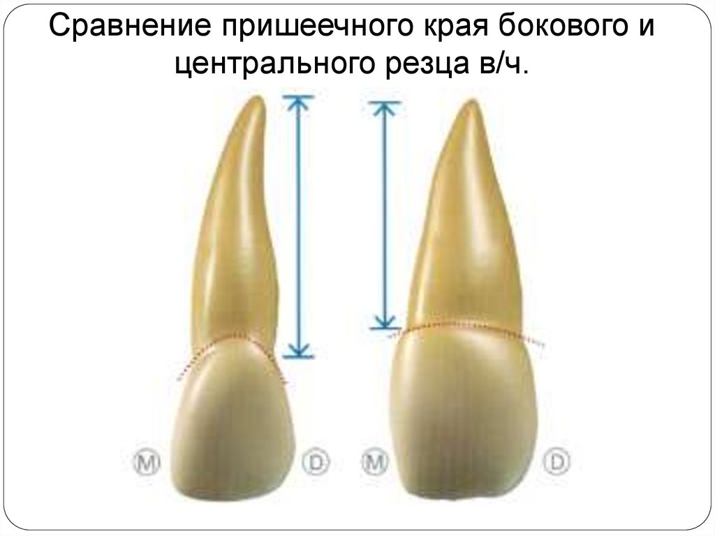 Высота нижних резцов