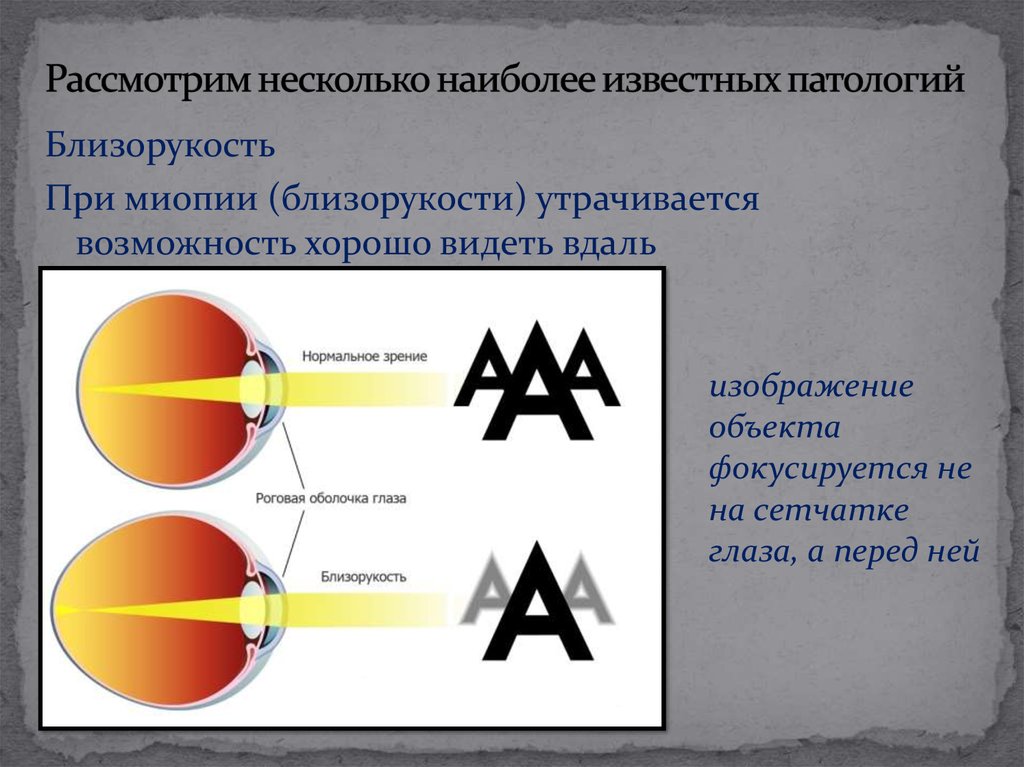 Несколько наиболее. Классификация миопии. Классификация миопии по степеням. Патологическая миопия. Миопия классифицируется на.