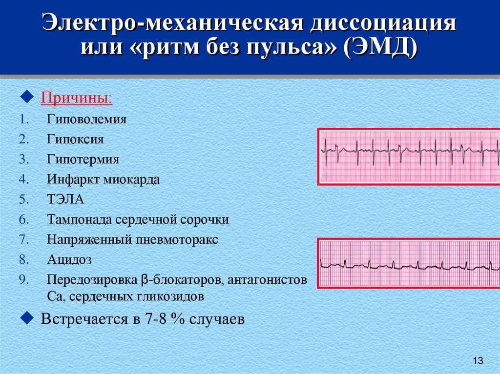 Признаки электромеханической диссоциации