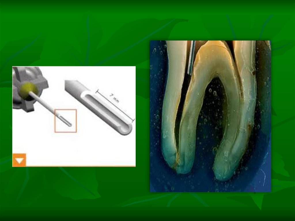 Антисептическая обработка корневых каналов. Препараты для ирригации корневых каналов. Медикаментозная обработка корневых каналов. Медикаментозная обработка канала зуба. Медикаментозная обработка корневого канала зуба.