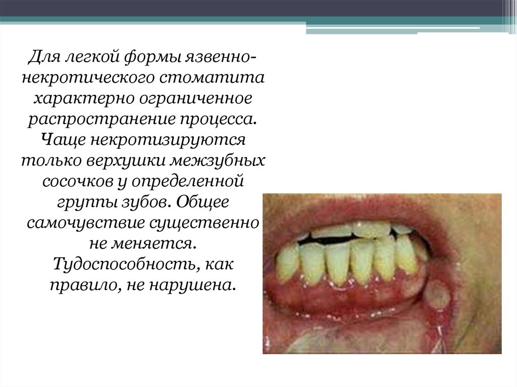 Язвенно некротический гингивостоматит фото