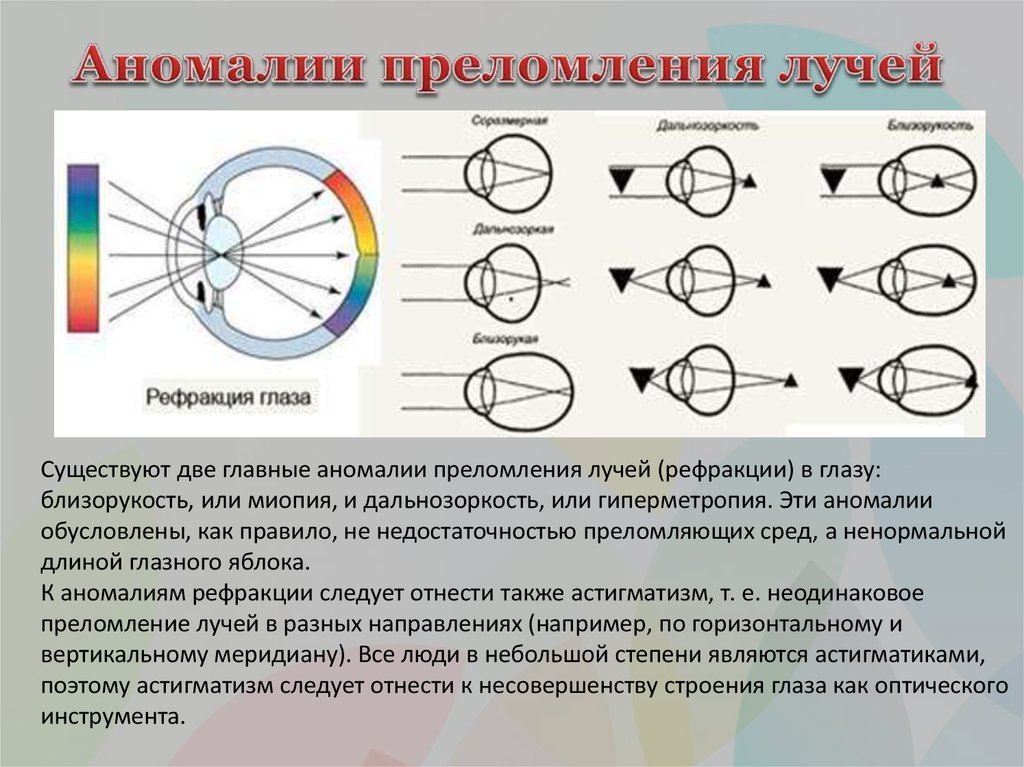 Миопия астигматизм глаз. Эмметропия миопия гиперметропия астигматизм. Близорукость ход лучей в глазе. Близорукость и дальнозоркость схема рефракции. Аномалии рефракции близорукость.