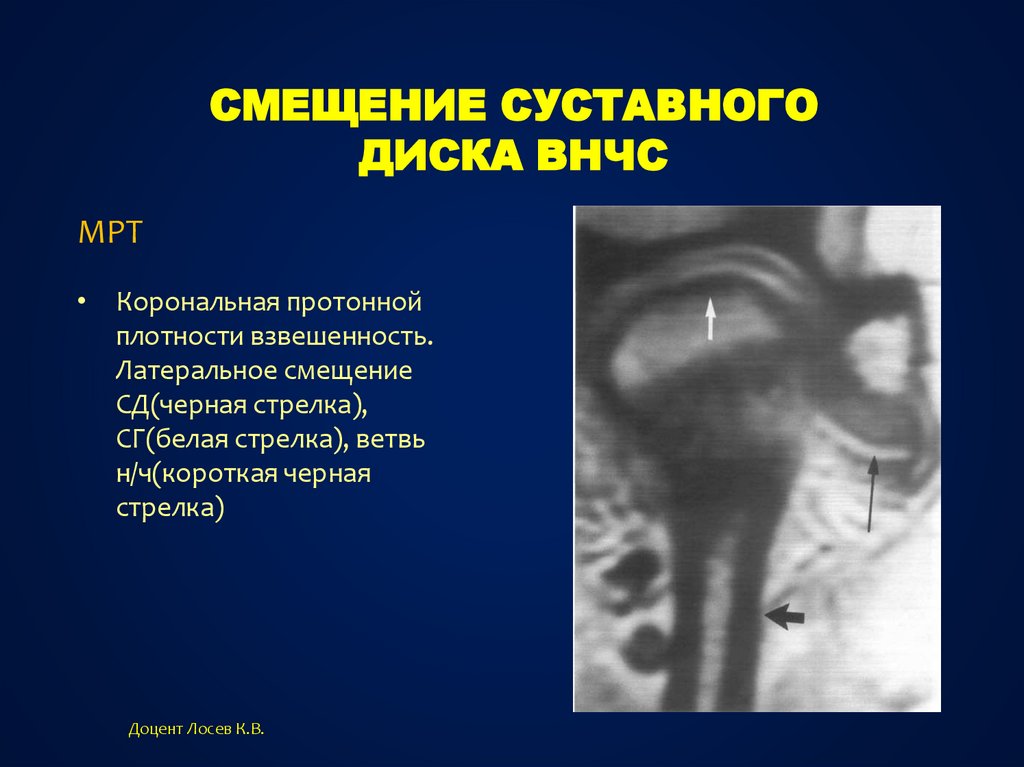 Суставной диск. Дислокация суставного диска ВНЧС. Подвывих диска височно-нижнечелюстного сустава.