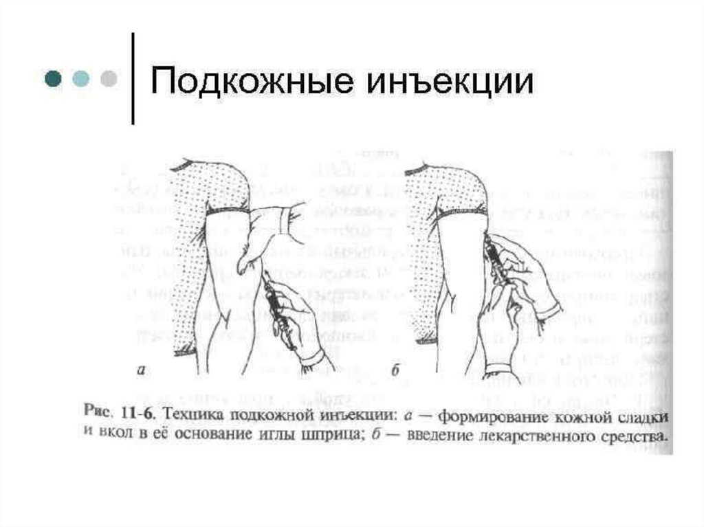 Выполнение п к инъекций. Схема подкожного введения уколов. Подкожные инъекции алгоритм схема. Алгоритм постановки подкожной инъекции в плечо. Подкожная инъекция в плечо техника.