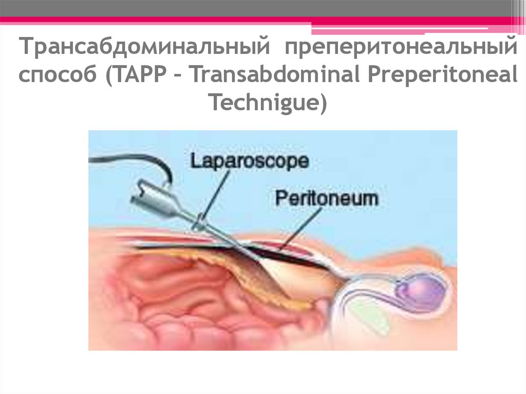 Трансабдоминальный преперитонеальный способ (TAPP – Transabdominal Preperitoneal Technigue)