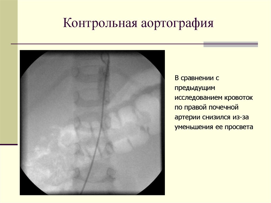 Аускультативная картина аортальной недостаточности тест