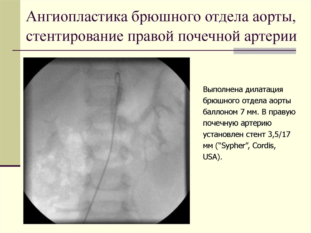 Для чего ставят стенд в почку