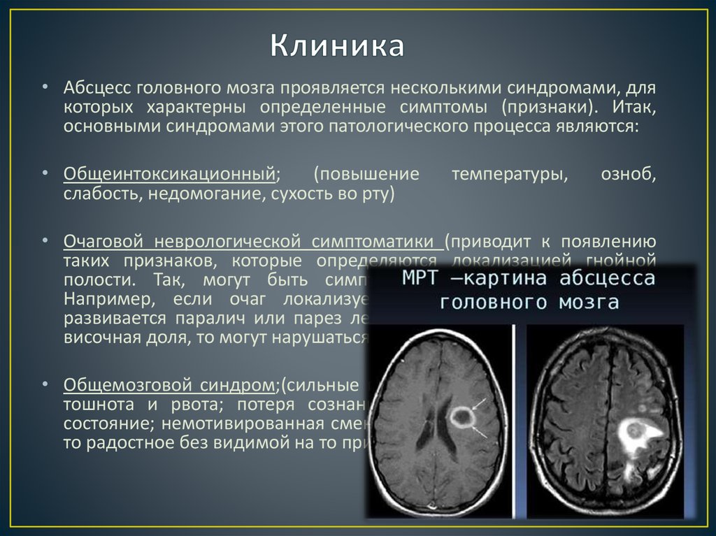 Абсцесс мозга симптомы. Абсцесс головного мозга клиника. Абсцесс головного мозга симптомы. Стадии формирования абсцесса головного мозга.