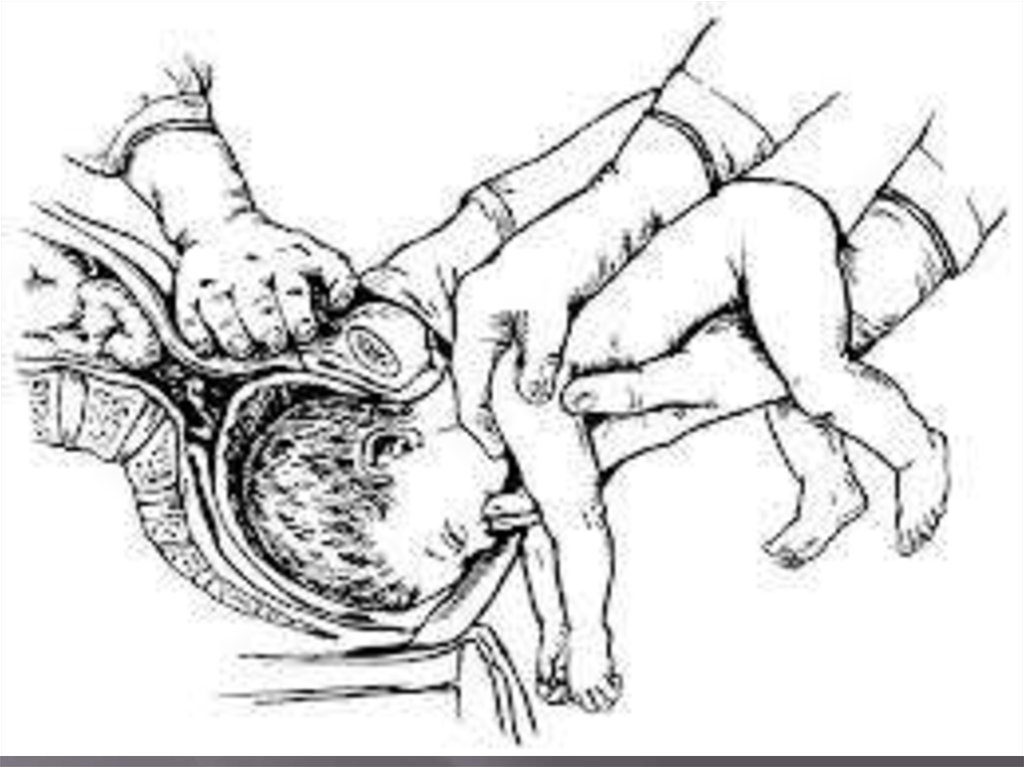 Путь ребенка во время родов. Выведение головки по Морисо-Левре-Лашапель.