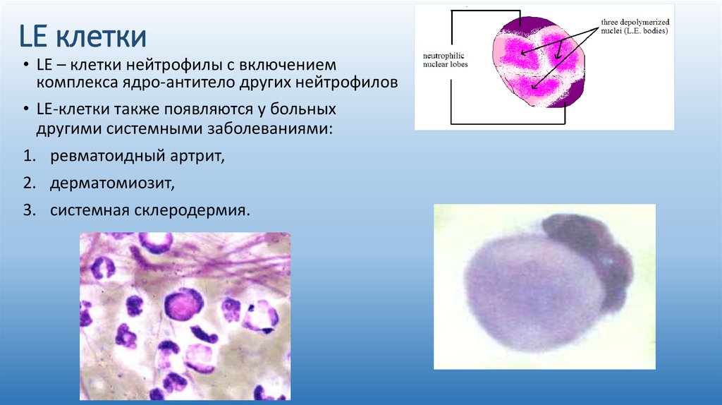 Le-клетки волчаночные клетки. Le клетки при системной красной волчанке.