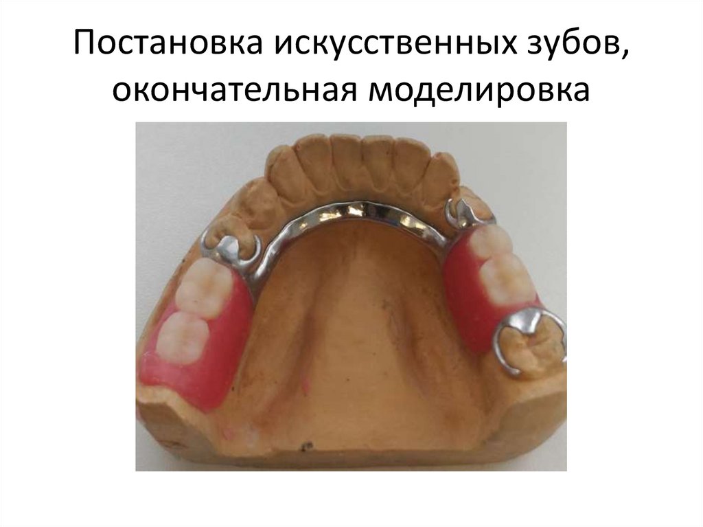 Бюгельное протезирование презентация