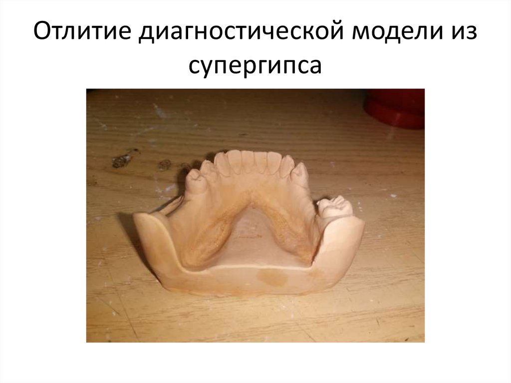 Нанесение рисунка каркаса бюгельного протеза на модель