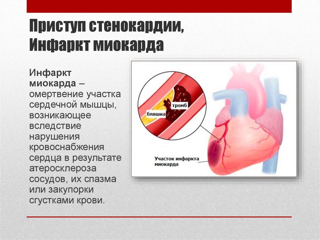 Ишемия отзывы. Ишемическая болезнь сердца стенокардия инфаркт миокарда. Форма сердца при инфаркте.