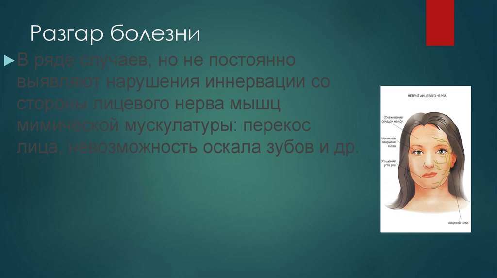 Разгар болезни. Лицо больного ботулизмом. Болезнь связанная перекошенным лицом.