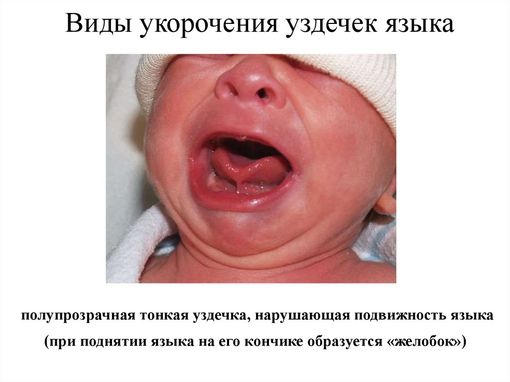 Виды укорочения уздечек языка