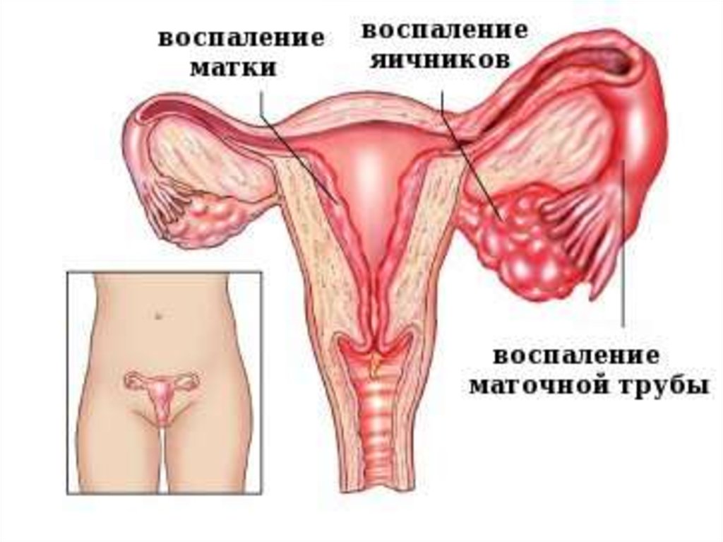 Придатки у женщин. Воспаление яичников сальпингоофорит. Аднексит (воспаление придатков).