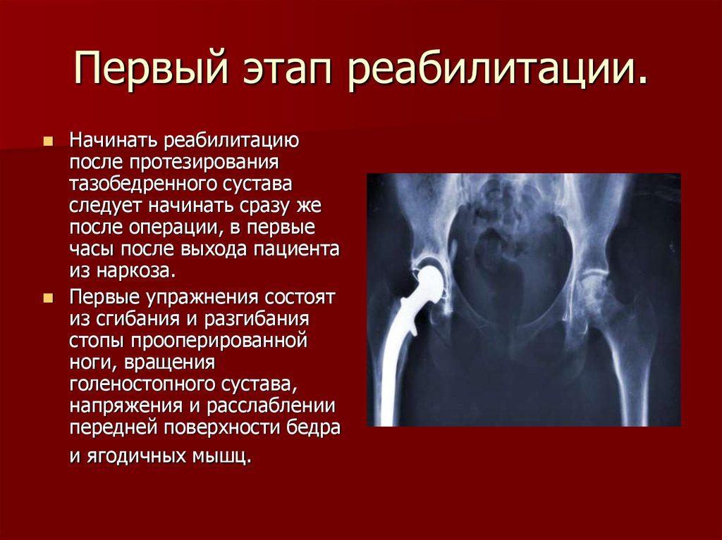 Замена тазобедренного сустава реабилитация. Этапы реабилитации после эндопротезирования тазобедренного сустава. Реабилитация после эндопротезирования таз.