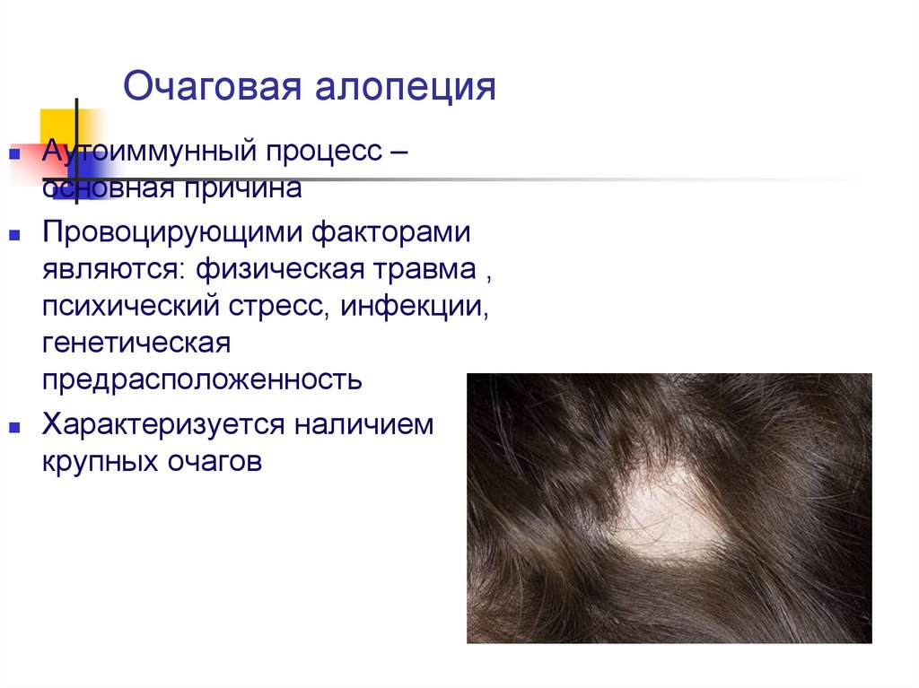 Алопеция у женщин лечение отзывы. Болезни волос алопеция презентация. Очаговая алопеция классификация.