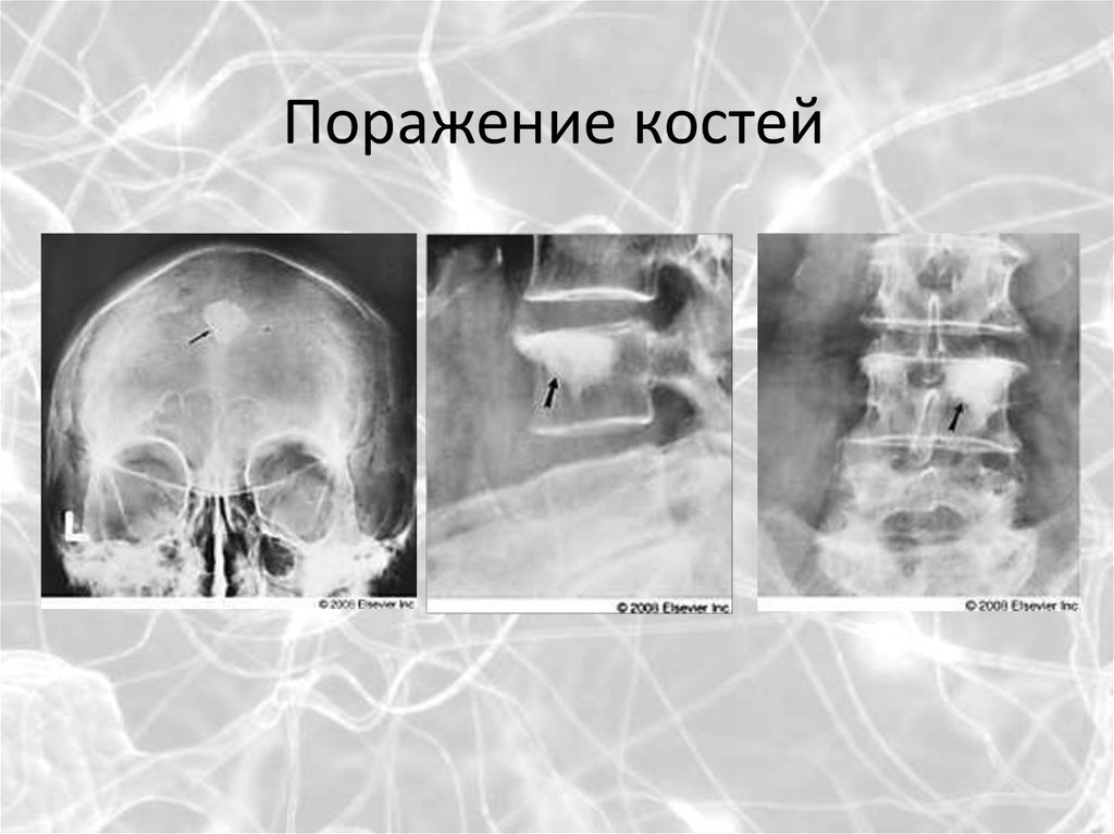 Вторичное поражение костей