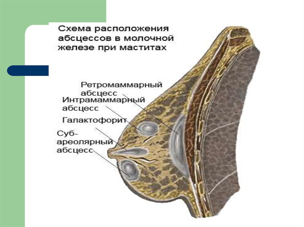 Молочные железы. Интрамаммарный мастит. Ретромаммарный абсцесс.