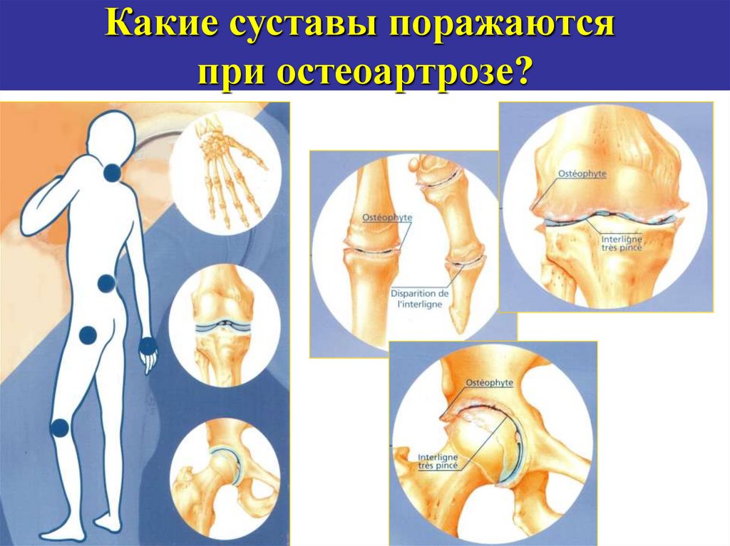 Суставы чаще. Остеоартроз поражаемые суставы. При остеоартрозе поражаются суставы. Суставы, наиболее часто поражаемые остеоартрозом. При остеоартрите наиболее часто поражаются суставы.