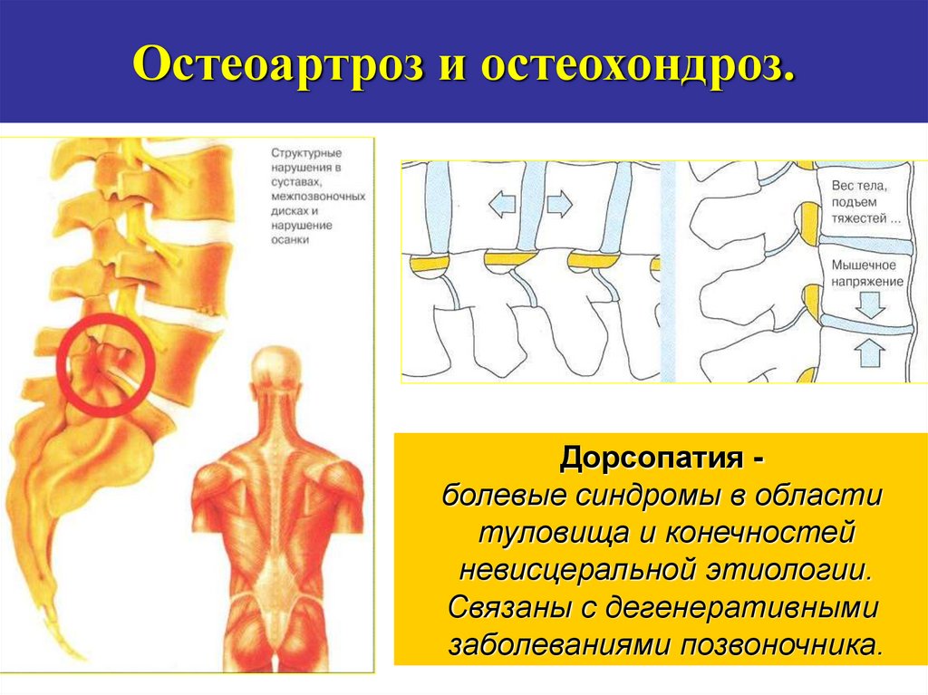 Дегенеративные заболевания позвоночника презентация