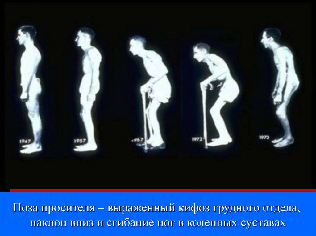 Анкилозирующий спондилоартрит презентация