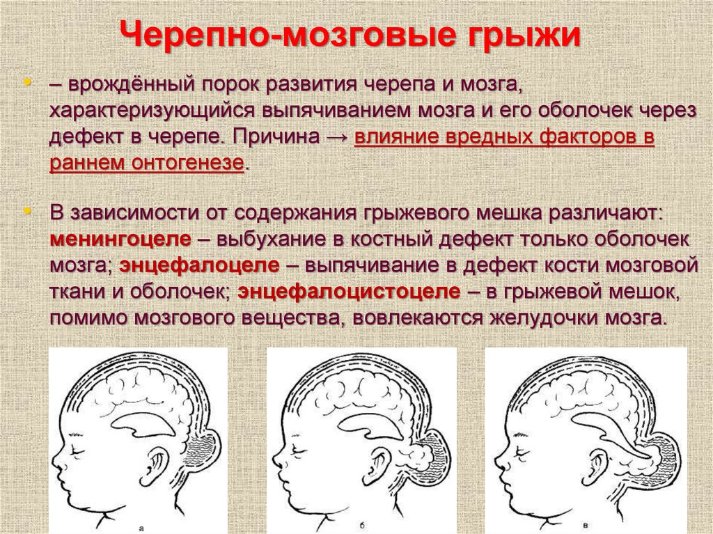 Нарушение развития головного мозга. Врожденные черепно мозговые грыжи. Черешня мозговая грыжа. Аномалии развития мозга. Пороки развития черепа и головного мозга.