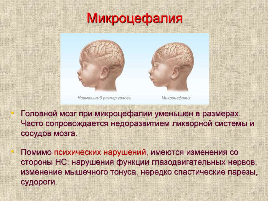 Внутриутробное недоразвитие головного мозга. Микроцефалия форма головы. Акроцкфалия. Микроцефалия у детей клинические рекомендации.