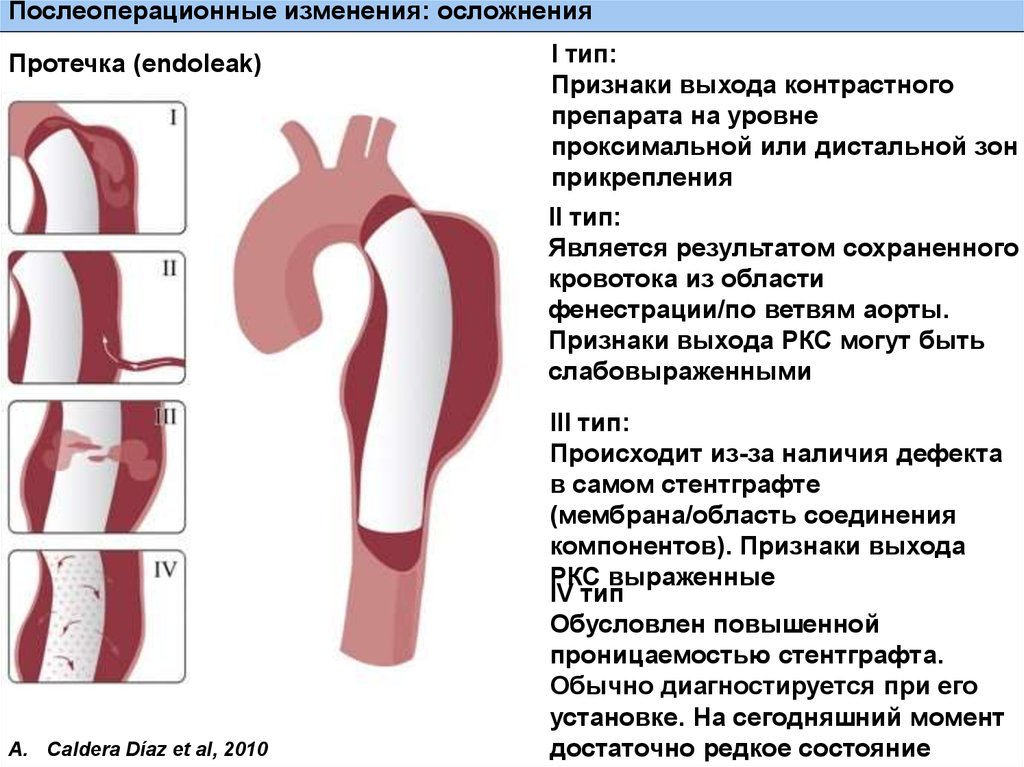 Симптомы аневризмы брюшной аорты