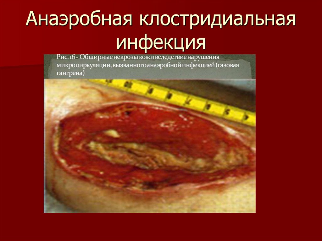 Анаэробная клостридиальная инфекция
