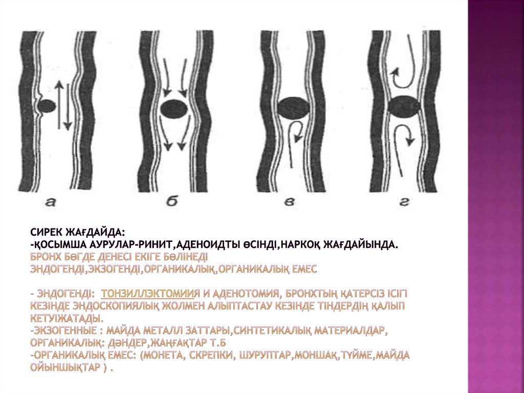 Сирек жағдайда: -қосымша аурулар-ринит,аденоидты өсінді,наркоқ жағдайында. Бронх бөгде денесі екіге бөлінеді