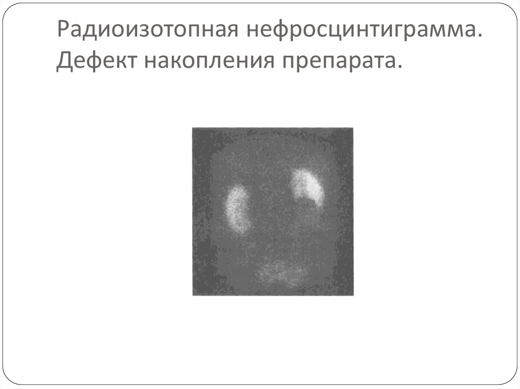 Радиоизотопная нефросцинтиграмма. Дефект накопления препарата.