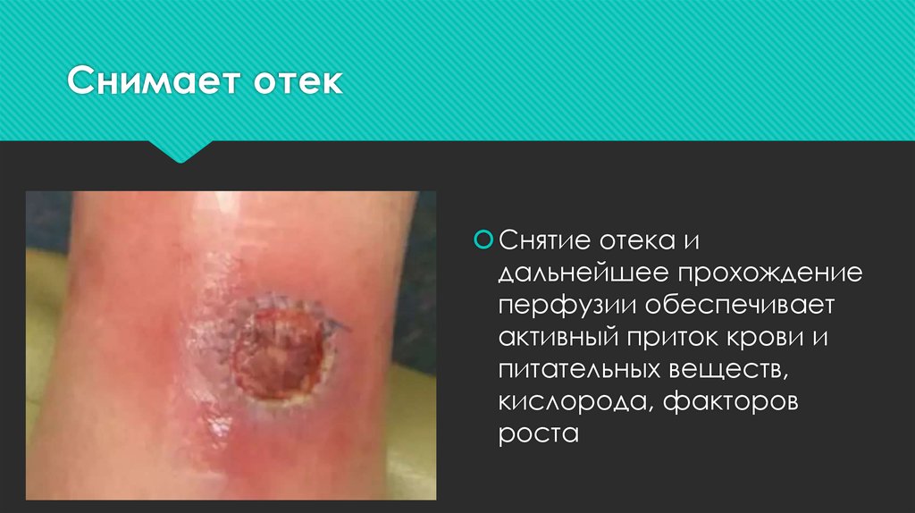 Снимает отек