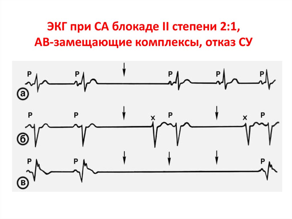 Экг 2. Синоатриальная блокада Мобитц 1 ЭКГ. Синоатриальная блокада 1 степени на ЭКГ. Синоатриальная блокада 2 степени на ЭКГ. При синоатриальной блокаде 1 степени на ЭКГ.