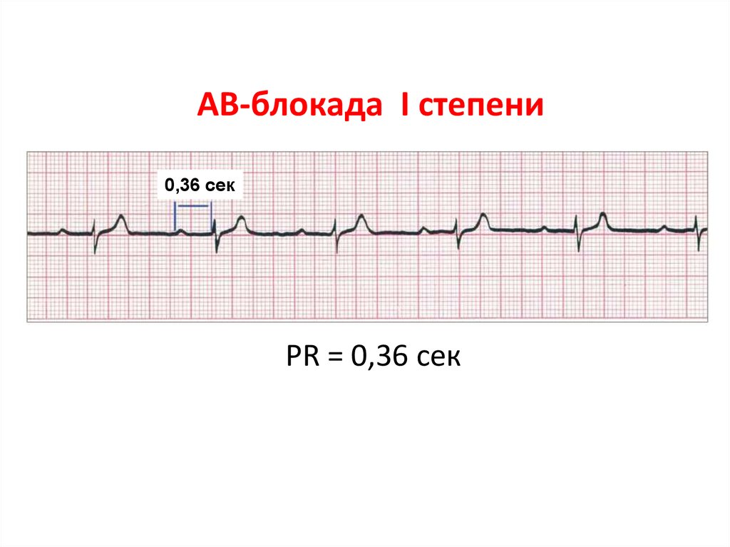 Ав блокады на экг картинки