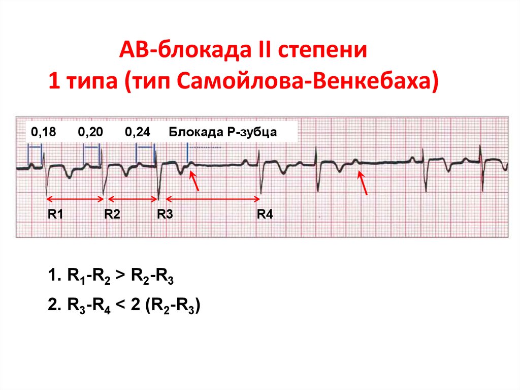 Синоатриальная блокада