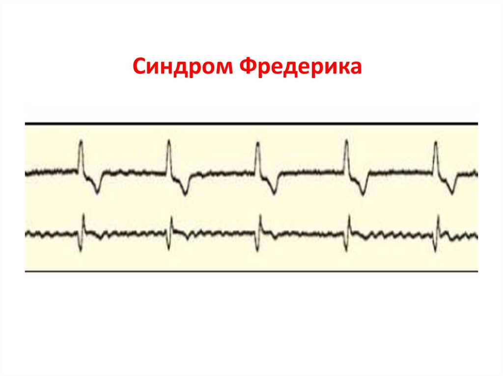 Синдром фредерика на экг фото