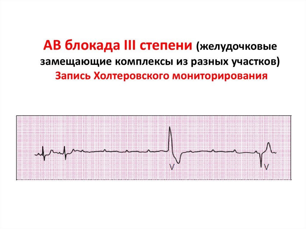Ав блокада. АВ блокада 3 степени заключение ЭКГ. Атриовентрикулярной блокады III степени.