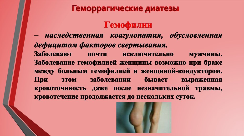 Геморрагический Васкулит Лечение Фото