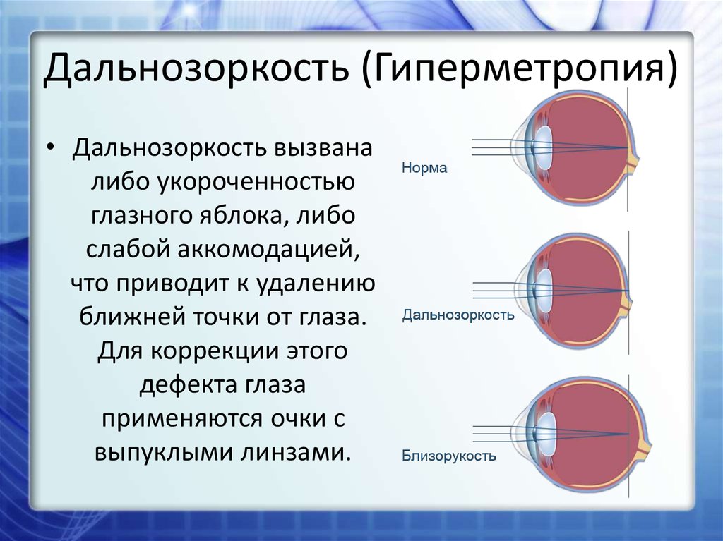 Причины возникновения дальнозоркости