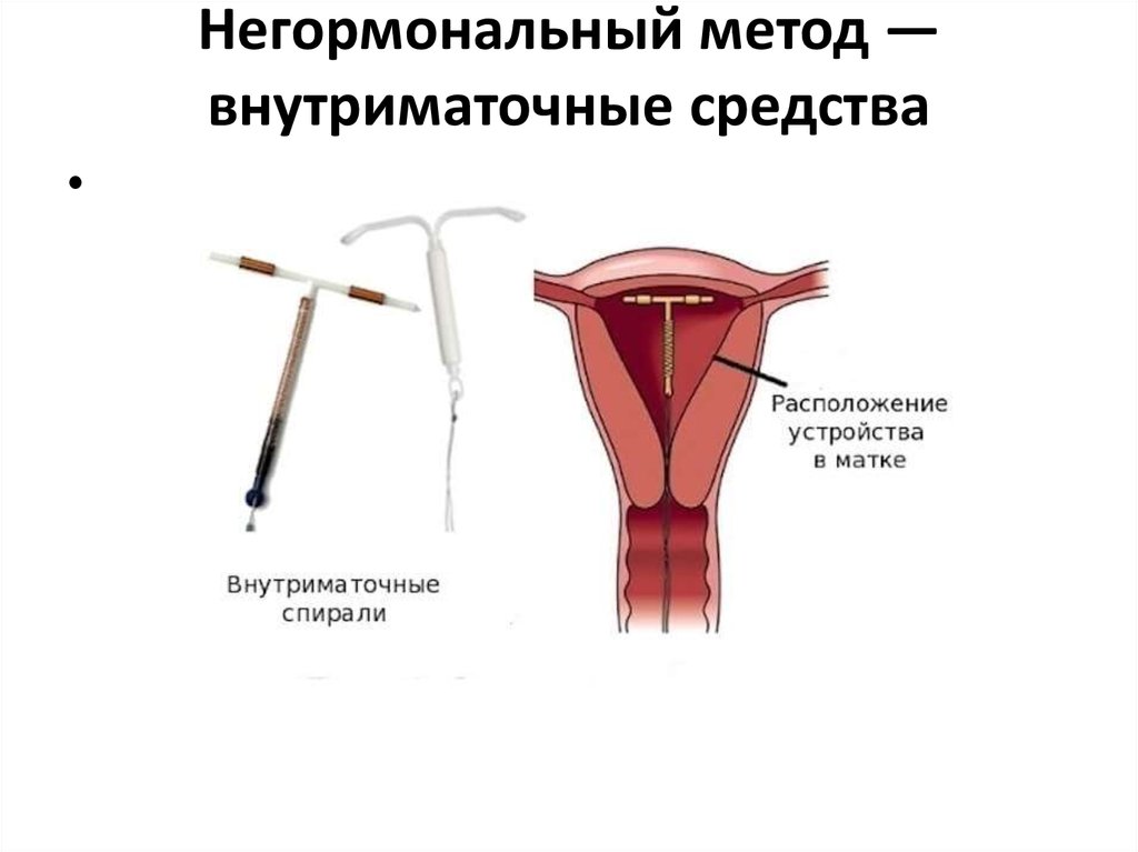 Негормональный метод — внутриматочные средства