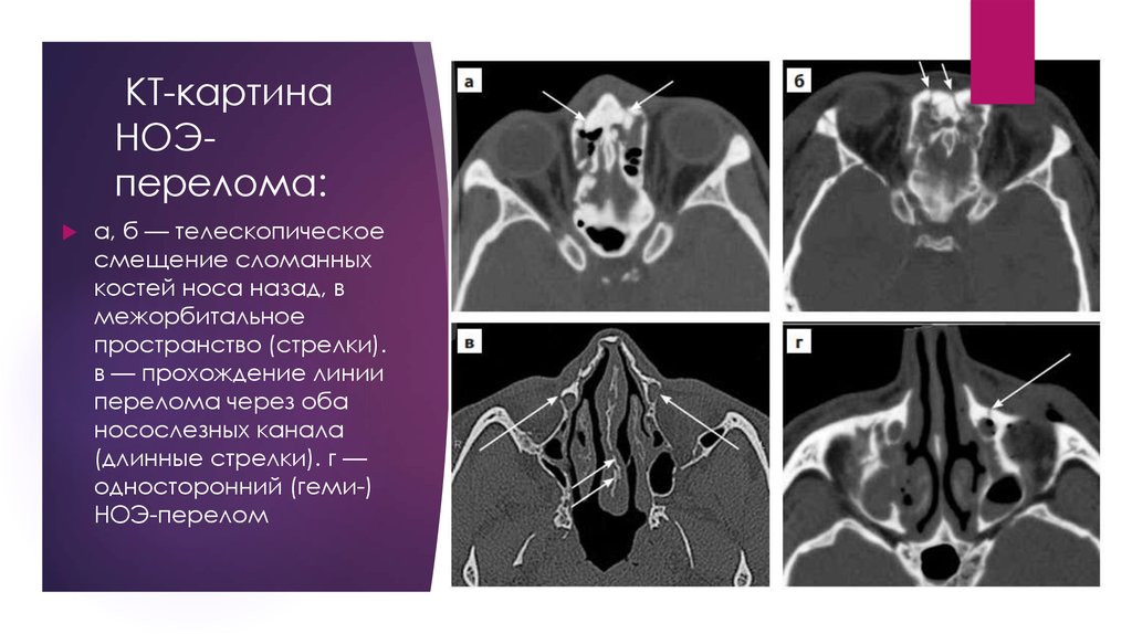 Свободно проходимы. Перелом костей носа кт. Кости носа кт анатомия. Кт картина перелома костей носа.
