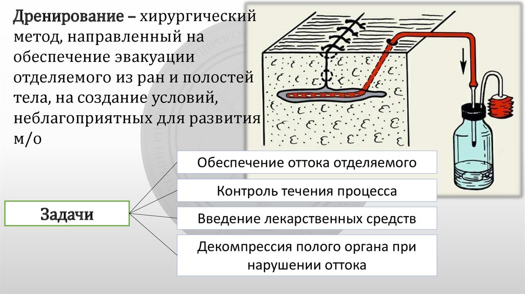 Дренирование. Дренирование антисептика. Способы дренирования раны. Методы дренирования в хирургии.