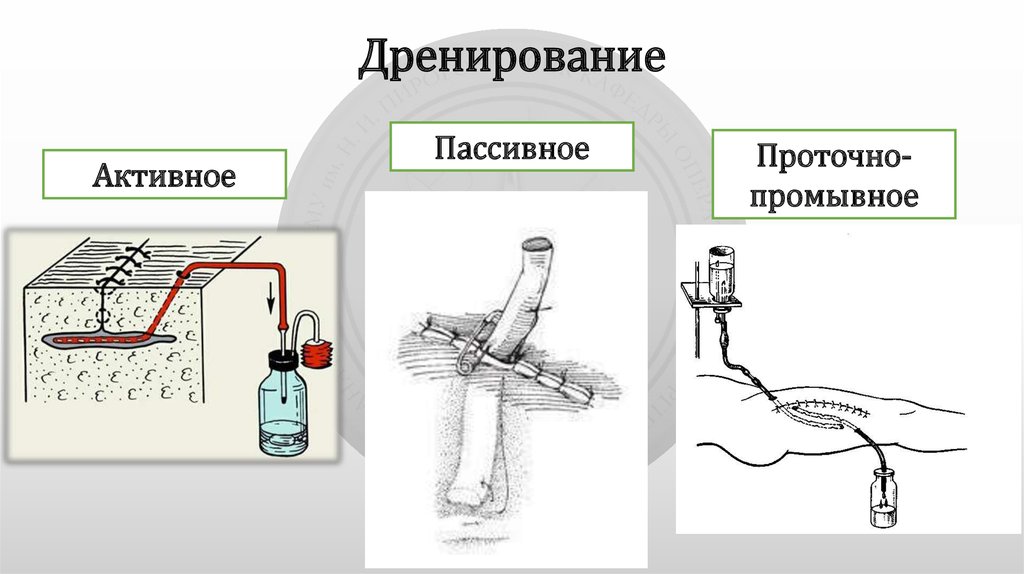 Установка антисептика. Пассивное дренирование РАН. Дренирование пассивное активное проточно-промывное. Активный и пассивный дренаж в хирургии. Пассивное и активное дренирование РАН.