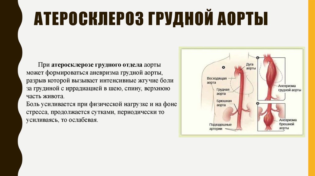 Атеросклероз брюшного. Атеросклероз грудного отдела аорты. Атеросклероз грудного отдела аорты и коронарных артерий. Атеросклероз брюшной аорты клиника. Клинические проявления атеросклероза аорты.