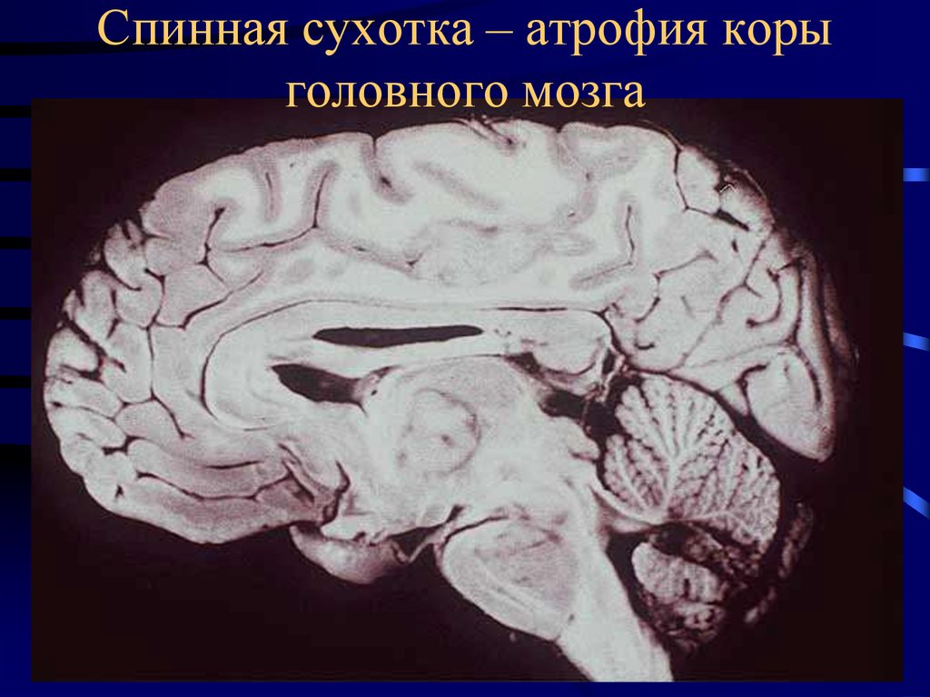 Умеренная атрофия мозга. Атрофические изменения коры головного мозга.